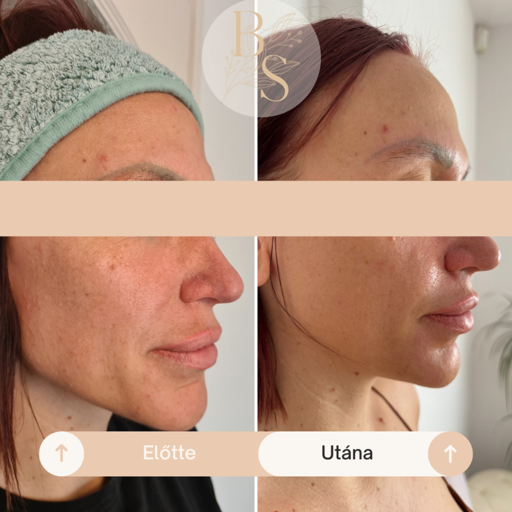 Hollywood Carbon Peeling