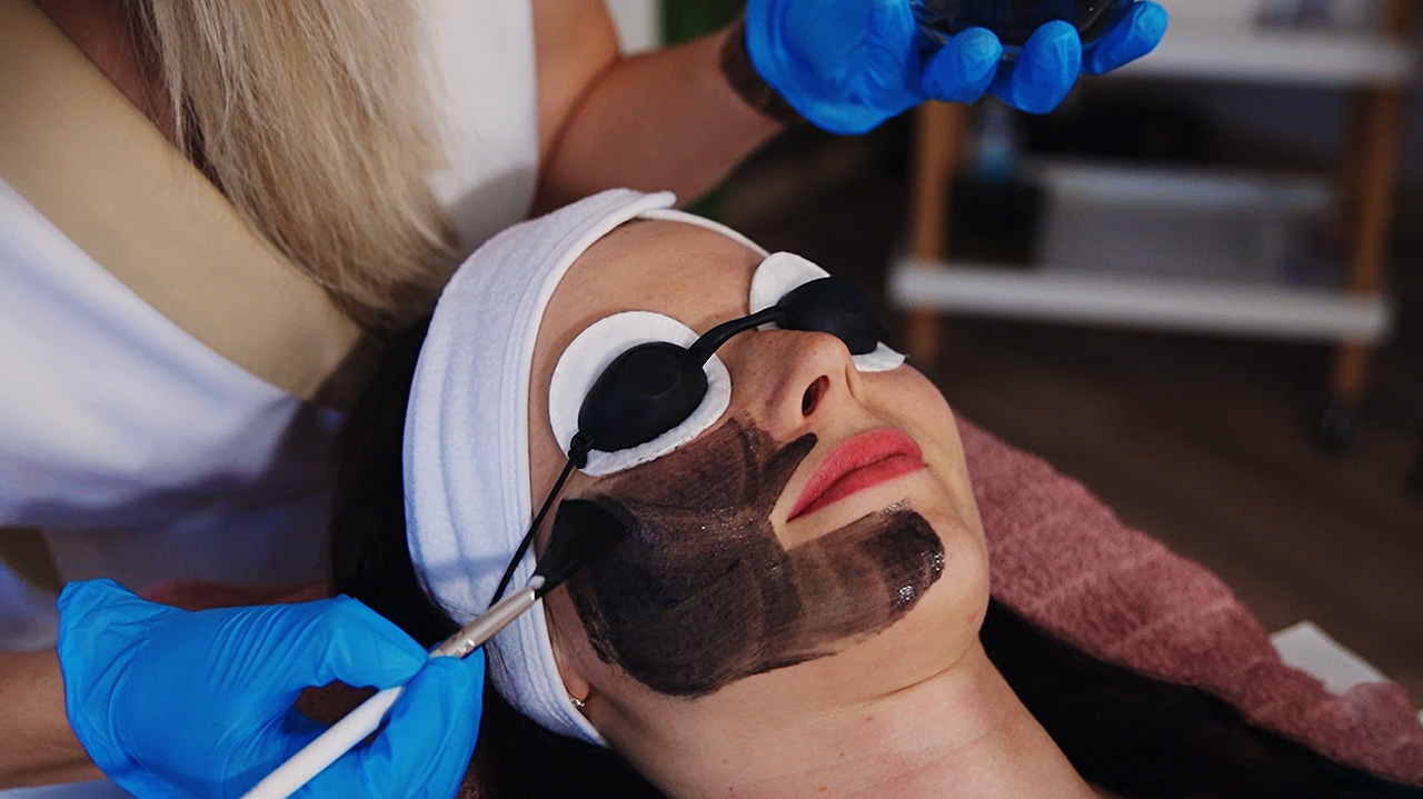 Hollywood Carbon Peeling lézeres szénporos arckezelés a Beauty Stories Esthetic szalonban